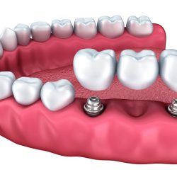 List the indications and contraindications for dental implants