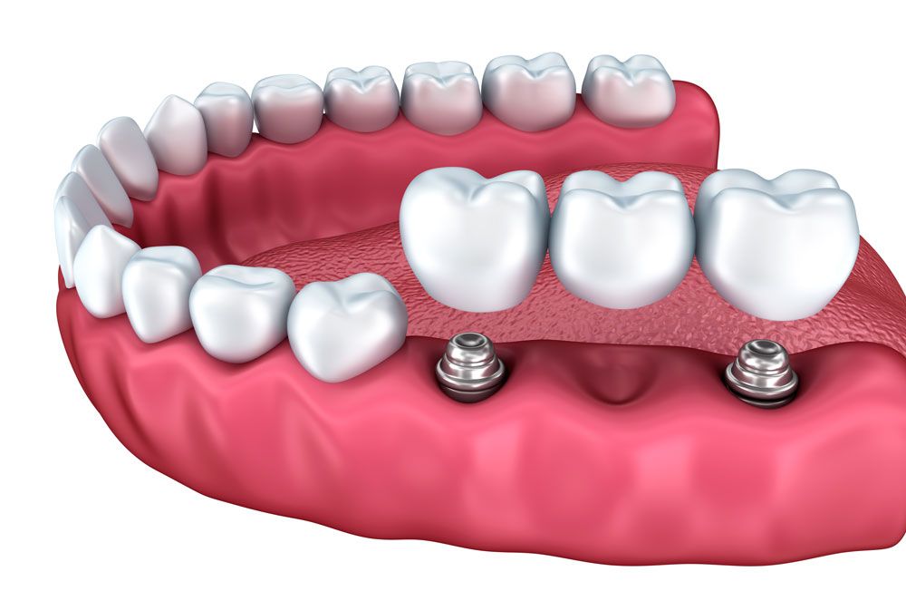 List the indications and contraindications for dental implants